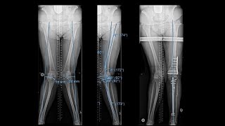 Knee Replacement Exercises  Phase 2 [upl. by Nilyarg]