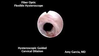 Hysteroscopicguided cervical dilation [upl. by Andres]