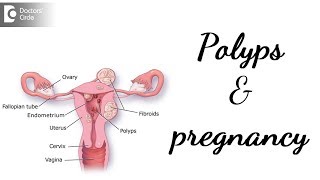 Colonic polyps and Colon Adenomas  Pathology [upl. by Cupo]