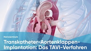 Aortic valve stenosis severe [upl. by Odlanir]