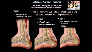 Calcaneal Avulsion Fractures  Everything You Need To Know  Dr Nabil Ebraheim [upl. by Betsy]