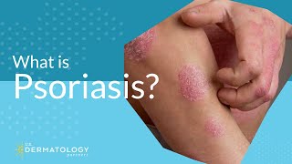 What Is Psoriasis [upl. by Anair]