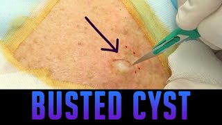 Ovarian Cysts Causes Symptoms amp Natural Treatment – DrBerg [upl. by Laurent]