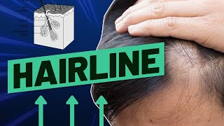 Uneven Hairline How To Fix It And What Causes It [upl. by Esilegna347]