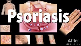 Psoriasis Types Symptoms Causes Pathology and Treatment Animation [upl. by Phelgen]