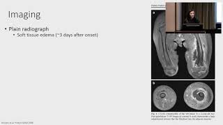 Chronic osteomyelitis [upl. by Aihsenet]