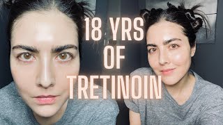 Not Seeing Results with RetinA TRETINOIN Watch This Before You Quit amp Avoid My Biggest Mistake [upl. by Down]