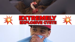 EXTREMELY EXPLOSIVE CYST [upl. by Eicyak505]