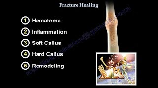 Phalanx Fractures  Everything You Need To Know  Dr Nabil Ebraheim [upl. by Jarrell]