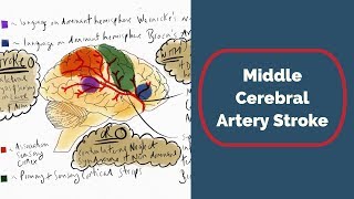 Middle Cerebral Artery Stroke [upl. by Dulsea]