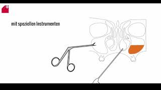 Nasennebenhöhlen OP  FESS  chronische Sinusitis [upl. by Schatz]
