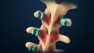 THE Best Exercises For Scoliosis [upl. by Wilkens]