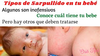 Tipos de sarpullidos en tu bebe  Conoce cual tiene tu bebe [upl. by Inaniel]