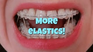 How I put my Braces Elastics on [upl. by Nomzzaj]