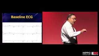 ECG Mini MasterClass Subtle ACS [upl. by Ackerley766]