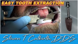 Easy Tooth Extraction  Dental Minute with Steven T Cutbirth DDS [upl. by Jasmina392]