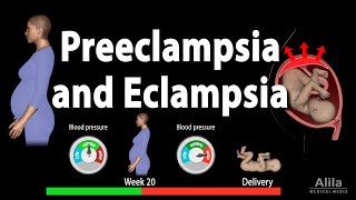 NCP 20 Nursing Care Plan on Eclampsia [upl. by Hadden]