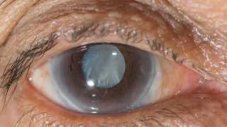 New eye drops may help treat cataracts [upl. by Sibby]