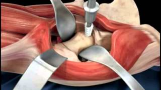 Hip replacement surgery techniques  Dr Scott Devinney [upl. by Mij]