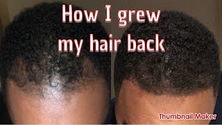 How to grow back receding hairline [upl. by Wilhelm177]