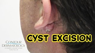 Angry Inflamed Neck Cyst  Dr Derm [upl. by Westmoreland]