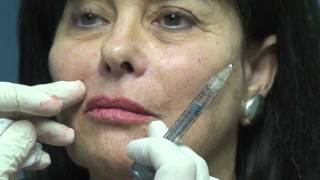 Juvederm Lip Augmentation in Fort Lauderdale [upl. by Renaud]