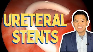 Ureteral Stent Insertion and Removal  Procedure in Detail [upl. by Elleon]