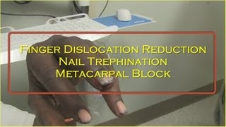 Thumb Dislocation and Reduction Medical Education amp Training [upl. by Eustis]