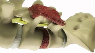 Transforaminal Lumbar Interbody Fusion TLIF  DePuy Videos [upl. by Nyltyak]