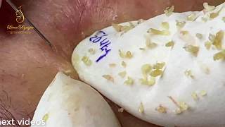 BLACKHEADS TREATMENT 93  Loan Nguyen [upl. by Steel]