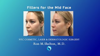 How to Restore Youthful Volume in the Midface using Fillers  Injectable Fillers by Dr Ron Shelton [upl. by Filahk]