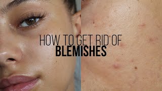 HOW TO GET RID OF BLEMISHES IN 3 DAYS  Jessicvpimentel [upl. by Aevin]