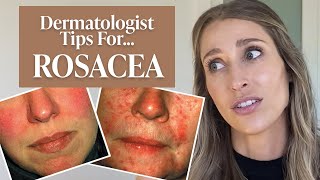 Dermatologist’s Guide to Rosacea What Is It Dos amp Don’ts Treatment Tips amp More  Dr Sam Ellis [upl. by Amorete]