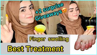 How To Treat Swollen Fingers At Home  Chilblains  Fingers Swelling in Winters  Dietitian Aqsa [upl. by Enohsal]