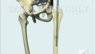 Femoral Fracture Fixation Surgery Intramedullary Nail [upl. by Hermione807]