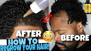 HOW TO GROW Your HAIRLINE BACK FAST [upl. by Swan]