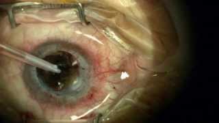 Corneal Replacement Surgery Corneal Transplant or Keratoplasty [upl. by Nwahsal]