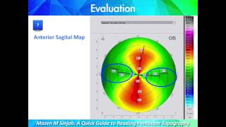 A Quick Guide to Reading Corneal Topography Part 1 [upl. by Akinwahs]