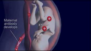 Jaundice Hemolytic Disease quotErythroblastosis fetalisquot in Newborn [upl. by Lela]