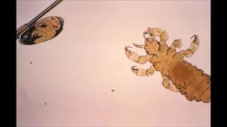 Pediculosis Head and body lice [upl. by Atinaej]