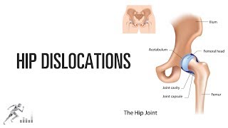 Hip dislocation [upl. by Yhtak]