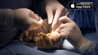 Carpal Tunnel Surgery [upl. by Eimia]