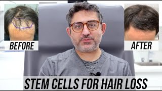 STEM CELL Hair Restoration 4 month Update [upl. by Anipsed]