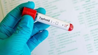 Typhoid Fever [upl. by Lidia]