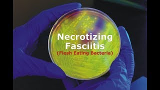 Necrotizing Fasciitis  Flesh Eating Bacteria [upl. by Salahi]