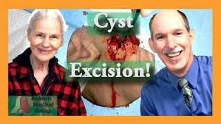 Calcified Cyst Removal – Gone within seconds [upl. by Eeniffar]