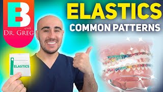 BRACES ELASTICS Most Common Patterns for Braces [upl. by Esiuqcaj]