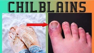 Chilblains causes symptoms treatment urduhindi [upl. by Weiman]