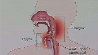 Good Question What Causes Laryngitis [upl. by Keverne64]