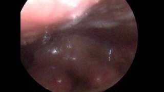 LPR  Laryngopharyngeal reflux [upl. by Ttirrej]